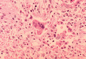 Measles_pneumonia_-_Histopathology